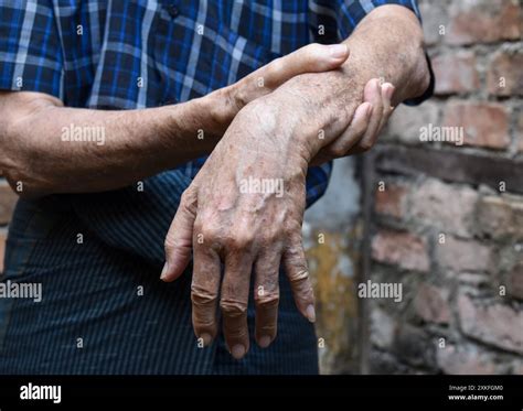 Radial nerve injury or wrist drop of Asian elder man Stock Photo - Alamy