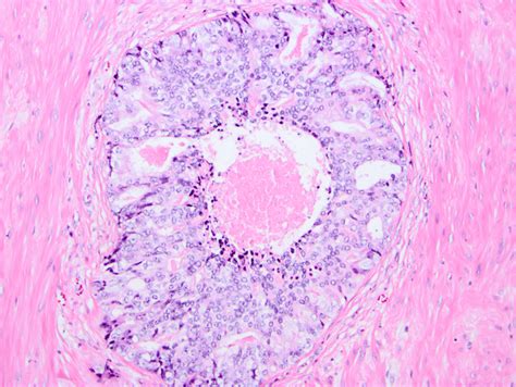 Impact of comedonecrosis on prostate cancer outcome: a systematic review - Aiyer - 2023 ...