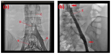 Familiar Disposition of May–Thurner Syndrome—A Case Series