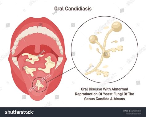 Candidiasis Treatment