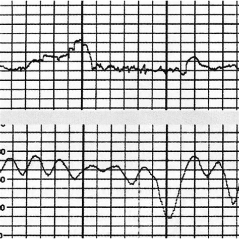 Sinusoidal fetal heart rate tracing following rupture of a vasa previa ...