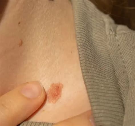 Wart Removal Treatment | Laser by Dermatologist | Uncover Clinics Delhi NCR