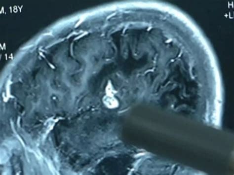 5-Inch Worm Removed From Chinese Man's Brain, It Was There For 17 Years