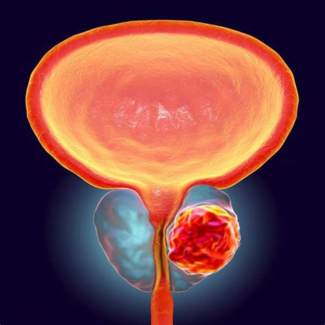 Digital Rectal Exams Solely Aren't Accurate In Detecting Prostate ...