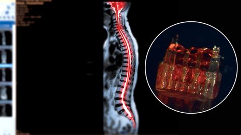 Tiny 3D-Printed Spinal Cords Could Reverse Paralysis, How Did ...