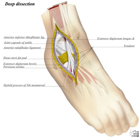 Image result for Ankle Anterolateral Approach Injection