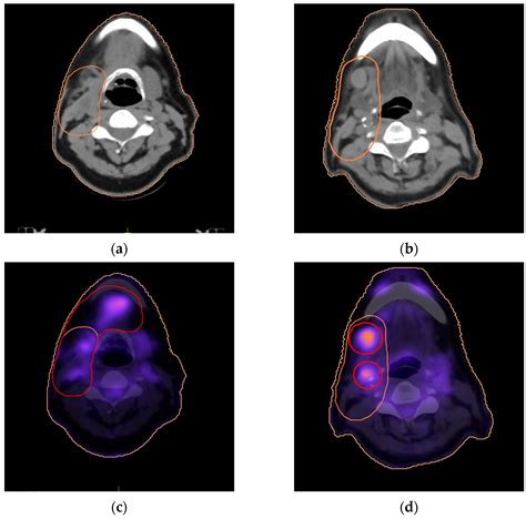18F-FDG PET-CT- vs. CT-Based Radiotherapy Treatment Planning for Head and Neck Cancer