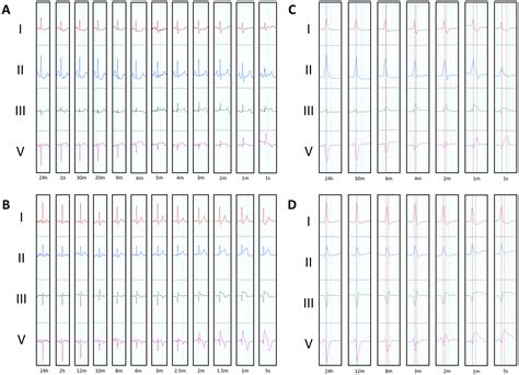 Electrocardiographic Right Ventricular Strain Precedes Hypoxic Pulseless Electrical Activity ...