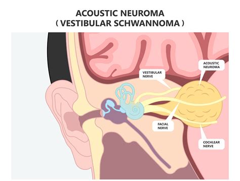 Exploring Non-Surgical Treatments For Acoustic Neuroma - Ask The Nurse Expert