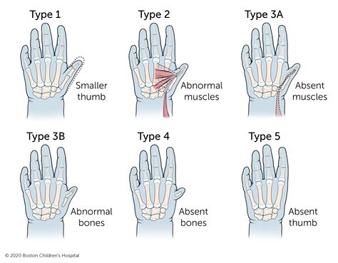 Thumb Hypoplasia and Aplasia | Boston Children's Hospital