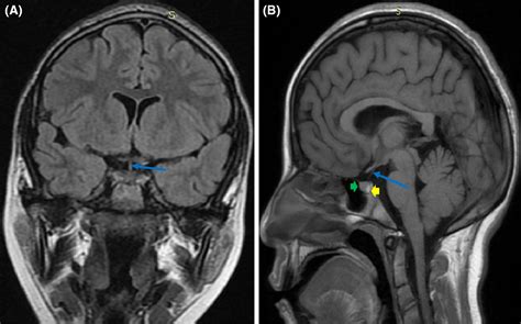 Pituitary stalk interruption syndrome on MRI: Case report - Yehouenou Tessi - 2023 - Clinical ...