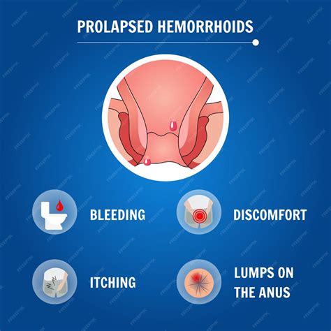 Infographie médicale hémorroïdes prolapsus | Vecteur Premium