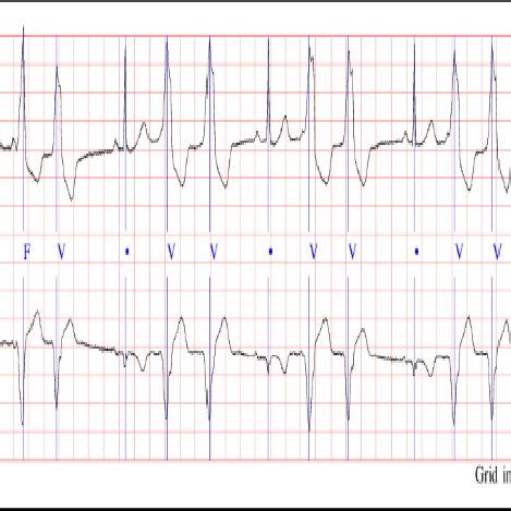 Labels of MIT-BIH Dataset 的图像结果