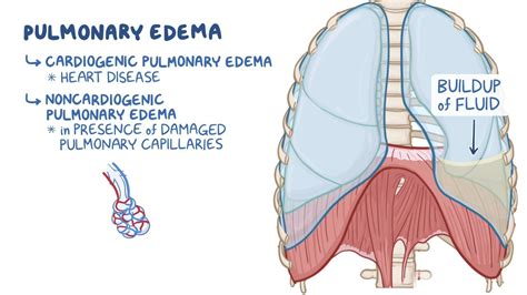 Pulmonary Vascular Congestion