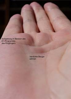 malvorlagen seite de quervain sehnenscheidenentz 252 ndung hannover schnellender finger malvorlagen seite de quervain sehnenscheidenentz 252 ndung hannover schnellender finger