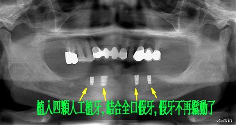 成功案例 - 大同牙醫診所- 三峽植牙牙醫推薦| 人工植牙,全口重建,全瓷冠,拔智齒