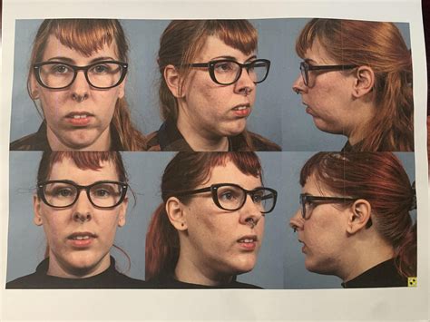 Had a lip flip about 1.5 weeks ago and have lost all control of my top ...