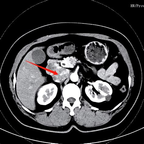 A rare tumor takes root in the largest vein in the human body, and ...