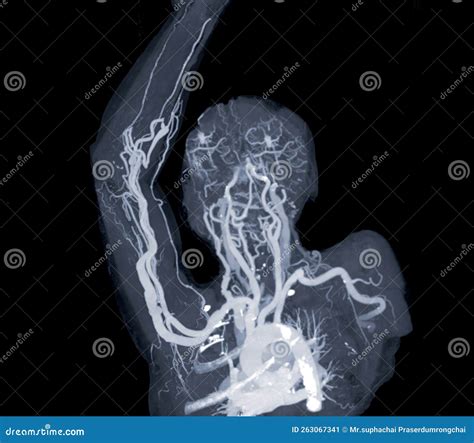 Brachial Arteries of the Arm with Upper Extremity Bone 3D Rendering ...