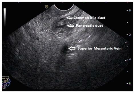Diagnostics | Special Issue : Diagnostic Value of Endoscopic Ultrasound ...