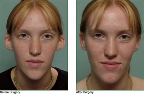 Image result for Ear Modification