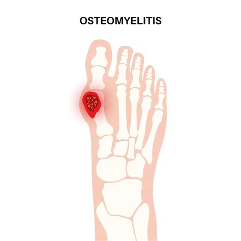 Premium Vector | Osteomyelitis disease infected feet bones pain and ...