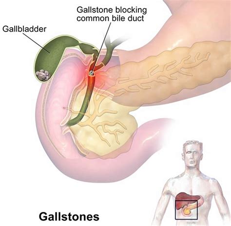 Gallstones causes, symptoms, pain, diet, diagnosis & gallstones treatment