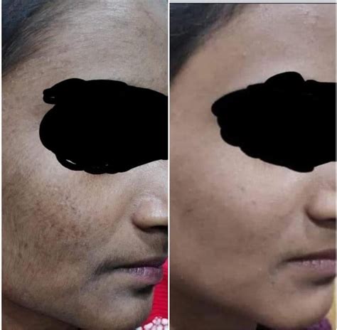Ojas Skin and Hair clinic-Moles And Warts Removal| Dermaroller ...