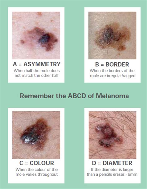 Types Skin Cancer Signs 的图像结果