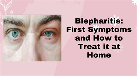 Blepharitis Swollen Eyelid Treatment Fast at Rita Skelley blog