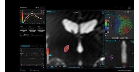 INSIGHTEC ANNOUNCES EXABLATE PRIME AVAILABILITY IN EUROPE -THE NEXT ...