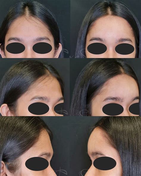 Dermal Fillers Forehead 的图像结果