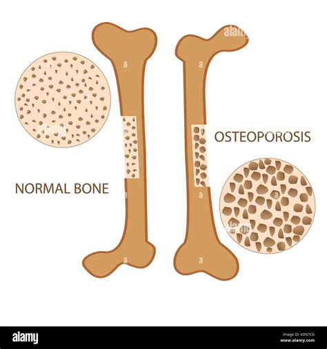 Osteomalacia Vs Osteoporosis Medscape