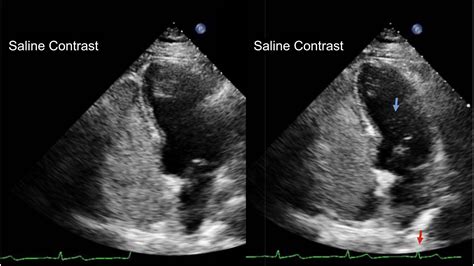Techniques for Identifying a Patent Foramen Ovale - Cardiology Clinics