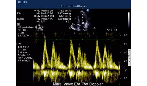 Philips - CX50 xMATRIX Compact cardiovascular ultrasound system