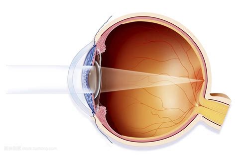 近视眼手术为什么没有普及换晶状体的方法？ - 知乎