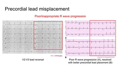 ECG – Pediatric Procedures