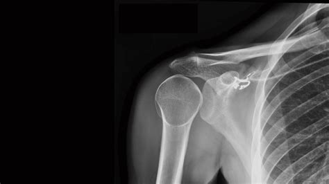 Image result for Posterior Shoulder Dislocation Sulcus Sign