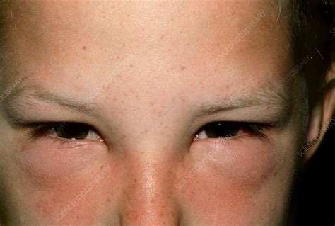 Hay fever: child's face with swollen eyes - Stock Image - M320/0136 ...