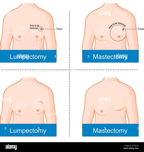 Breast cancer treatment before and after Breast surgery. difference between Mastectomy and ...