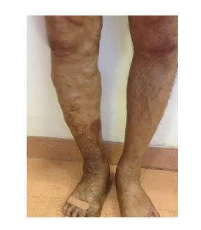 symtoms for varicose veins, telangiectasias treatment in chennai