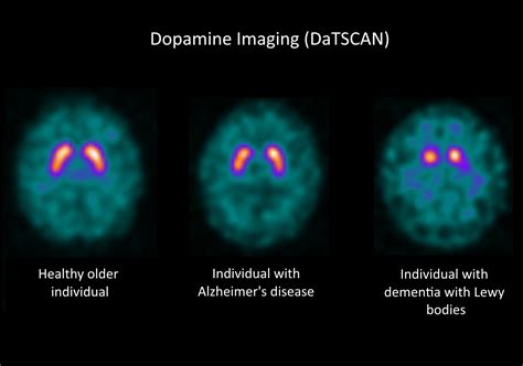 Dementia and Imagination | Northern Innovation | Newcastle University