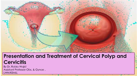 SOLUTION: Obstetrics gynecology presentation and treatment of cervictis ...