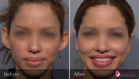 Image result for Ear Modification