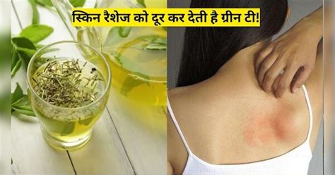 How To Get Rid Of Skin Rashes Problem Use Green Tea | Hindi News, स्किन ...