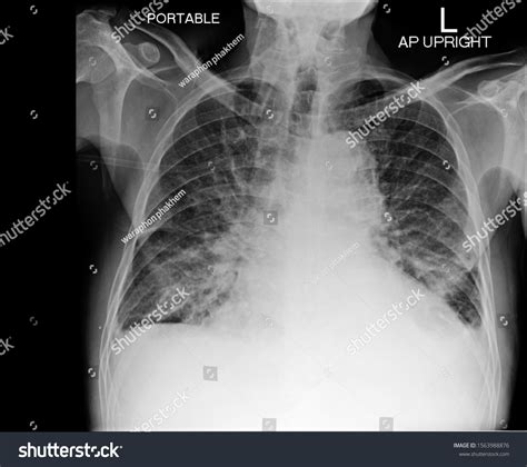 133 Oedema Heart Failure Images, Stock Photos & Vectors | Shutterstock