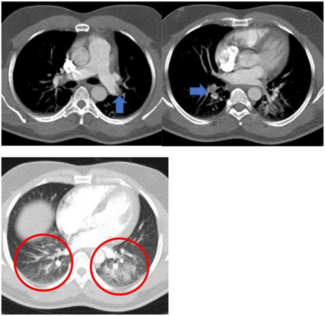What is a pulmonary embolism, the condition that led to Catherine O’Hara’s death? | CNN