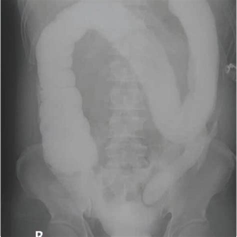 Image result for Distal Loopogram