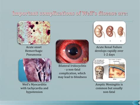 Symptoms Of Weil's Disease In Humans