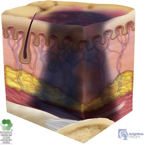 Deep Tissue Pressure Injuries - Critical Care Nursing Clinics